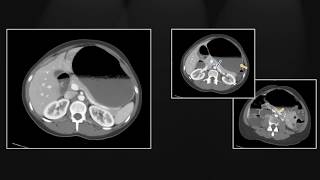 Superior Mesenteric Vessel Emergencies  Interesting Radiology Cases [upl. by Aig621]