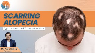 What is scarring alopecia  Types Causes Diagnosis and treatment options  Dr Alok Sahoo [upl. by Elsilrac981]