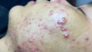 ACNE TREATMENT VU QUYNH MI Blackheads On Boy Face 2024 [upl. by Dorolice577]