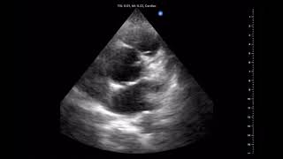 Ultrasound images of my excited heart [upl. by Osithe]