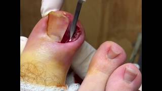 Chronic Ingrown Toenail with pyogenic granuloma formation [upl. by Katherin6]