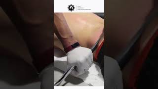 Treating lower back pain with Scraping  GUASHA  GRASTON  IASTM [upl. by Stew]