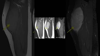 Musculoskeletal fibromatosis mrielbow anatomy [upl. by Delphinia]