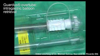 GUARDUS™ Overtube Intragastric Balloon Retrieval [upl. by Pincince721]