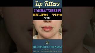 Dr Charbel Medawars New Lip Filler Technique beforeandafter beauty lebanon glowup viral fyp [upl. by Yenetruoc]