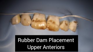 How to Isolate with Rubber Dam in Upper Anteriors  Rubber Dam Placement in Maxillary Front Teeth [upl. by Adas]