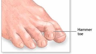 how to get rid of hammertoes without surgery [upl. by Bowles]