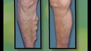 Varicose Vein Treatment by Laser  Endovenous Saphenous Vein Ablation  ELVES [upl. by Aisatana737]