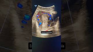 Endometrial Hyperplasia ultrasound shorts uterus [upl. by Goulden]