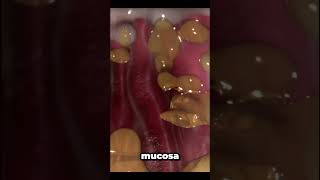 helicobacter pylori infection [upl. by Trescott374]