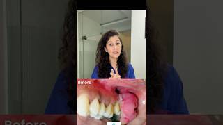 Pregnancy tumour  gums infection during pregnancyviralvideo dental shorts gumdisease trending [upl. by Seidnac]