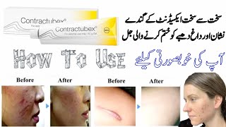 contractubex  contractubex gel  contractubex gel how to use  contractubex gel for acne scars [upl. by Acinorej]