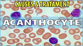 What is Acanthocyte Causes Symptoms and Treatments [upl. by Nylicaj]