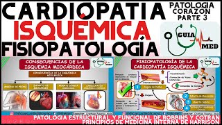 CARDIOPATÍA ISQUÉMICA FISIOPATOLOGÍA  GuiaMed [upl. by Akem]