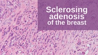 Sclerosing Adenosis of the Breast  Pathology mini tutorial [upl. by Niarb474]