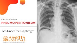 Case Discussion  Pneumoperitoneum  Gas Under the Diaphragm [upl. by Hedda]