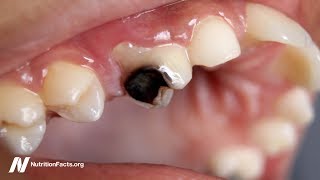 How to Stop Tooth Decay [upl. by Lebasy]