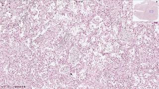 Pneumocystis Jirovecii Pneumonia  Histopathology [upl. by Starobin]