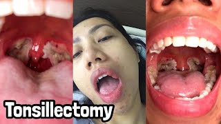 ENG SUB TONSILLECTOMY SURGERY DURING CORONAVIRUS  Surgery amp Recovery VLOG [upl. by Noitsuj]