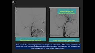 Preoperative embolization of juvenile nasopharyngeal angiofibroma [upl. by Anayra]