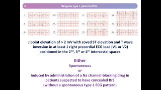 Diagnosis of Brugada in a nutshell English Version [upl. by Machutte]