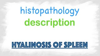 Hyalinosis of Spleen Histopathology [upl. by Arded316]