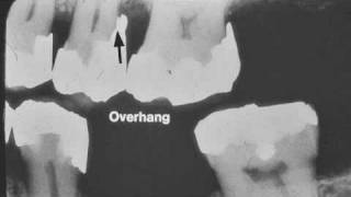 Dental Radiograph Pathology amp Restorations  Part I [upl. by Primrose]