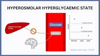 Hyperosmolar Hyperglycaemia State [upl. by Pollitt763]