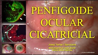 Penfigoide Ocular Cicatricial [upl. by Nedyah]