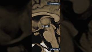 Recognizing the Warning Signs of a Stroke A LifeSaving Guide [upl. by Alyakim]