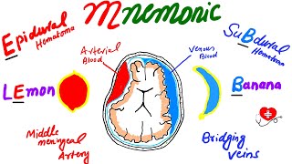 Extradural hematoma vs Subdural hematoma mnemonic for plab [upl. by Pegasus]