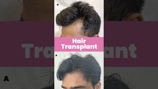 Hair Transplant Case Study  Hair Transplant Before and After  Hair Growth Androgenetic Alopecia [upl. by Moberg]