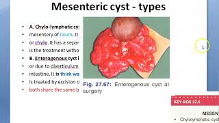 Surgery 665 Mesenteric cyst Peritoneum chylolymphatic enterogenous Tillaux triad pseudo lymph node [upl. by Dyun871]