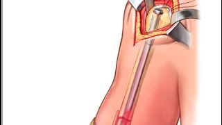 Right Humeral Intramedullary Nailing [upl. by Fey]