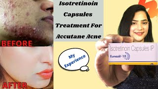 My Experience With Isotretinoin Isotretinoin Capsule for acneBefore amp AfterBenefitsSide Effects [upl. by Oyr676]