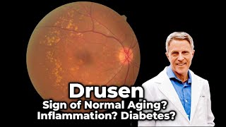 Drusen  Sign of Normal Aging Inflammation Diabetes [upl. by Rumery950]