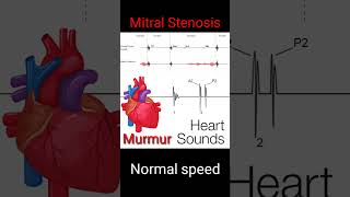 Normal Heart sounds and murmur Auscultation mitral valve stenosis murmur of heart in diastole [upl. by Irihs689]