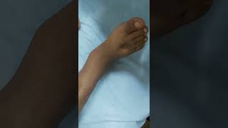 Pitting edema  DCLD patient clinicalexamination hospital doctor [upl. by Cappella]