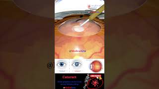 Cataract  Lens Implant  Medical Arts Shorts  3d animation surgery [upl. by Yesnyl]