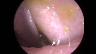 271  Ear Wax Removal using Jobson Horne Zoellner Sucker and Sodium Bicarbonate [upl. by Grobe338]