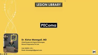 Pathology of PEComa [upl. by Yboc]