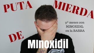 9º Meses con MINOXIDIL PUTA MIERDA DE MINOXIDIL [upl. by Eastman199]