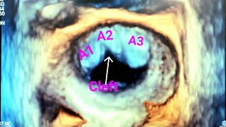 Ostium Primum ASD associated with Mitral Cleft and Moderate MR reviewed using 3D TEE [upl. by Yntruoc]