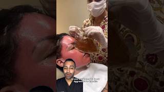 The most EXTREME Chemical Peel 😵 Dr Somji Reacts [upl. by Eshman]