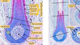 Infundibular keratinizing acanthoma [upl. by Armillia]