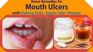 Home Remedies for Mouth Ulcers  Get Rid Mouth Ulcers with Baking Soda Apple Cider Vinegar [upl. by Arinay730]