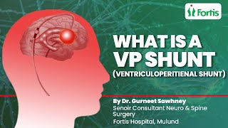 Ventriculoperitoneal Shunt  What Is A VP Shunt Used For  Is VP Shunt A High Risk Surgery  MUL [upl. by Notnirb]