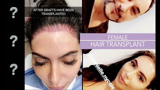 Female Hair Transplant Surgery Danielle Surgery Day and PostOp [upl. by Maddis634]