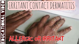 Dermatology  Approach to dermatitis  Irritant vs Allergic  Dr Suchana Marahatta [upl. by Berlauda686]