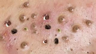 Satisfying big blackhead removal  Pimple popping 120 [upl. by Coney536]